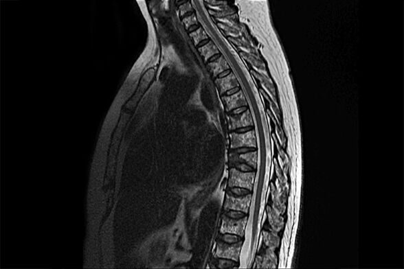 Krūškurvja osteohondrozes izpausmes MRI tēlā