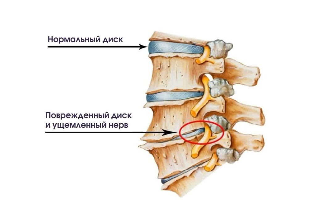 Dzemdes kakla osteohondrozes simptomi