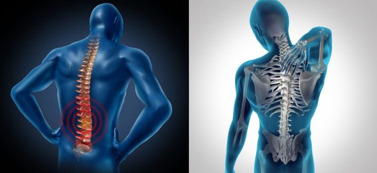 Iekaisums mugurkaula osteohondrozes gadījumā