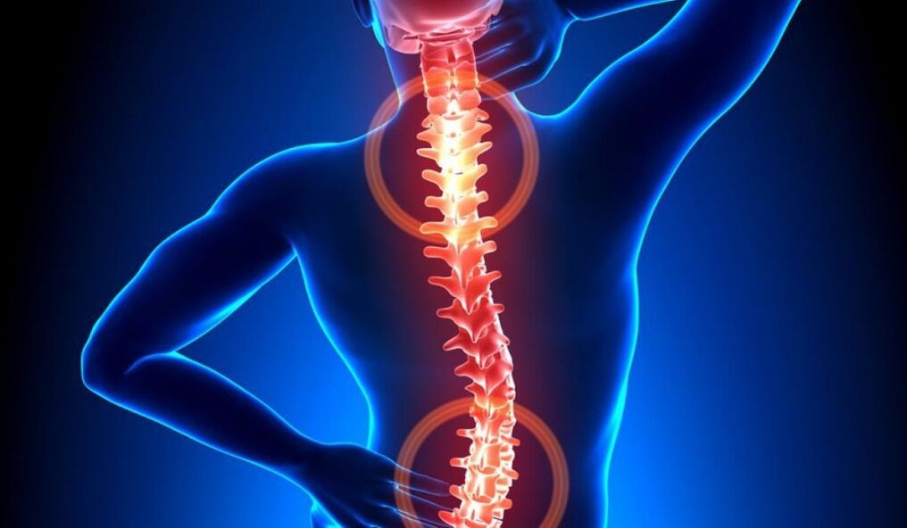 mugurkaula osteohondroze