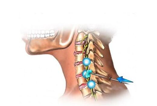 dzemdes kakla osteohondrozes ārstēšana